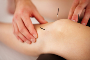acupuncture injury treatment